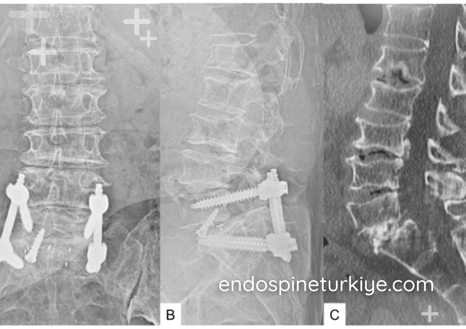 Bel kayması (spondilolistezis) belirtileri