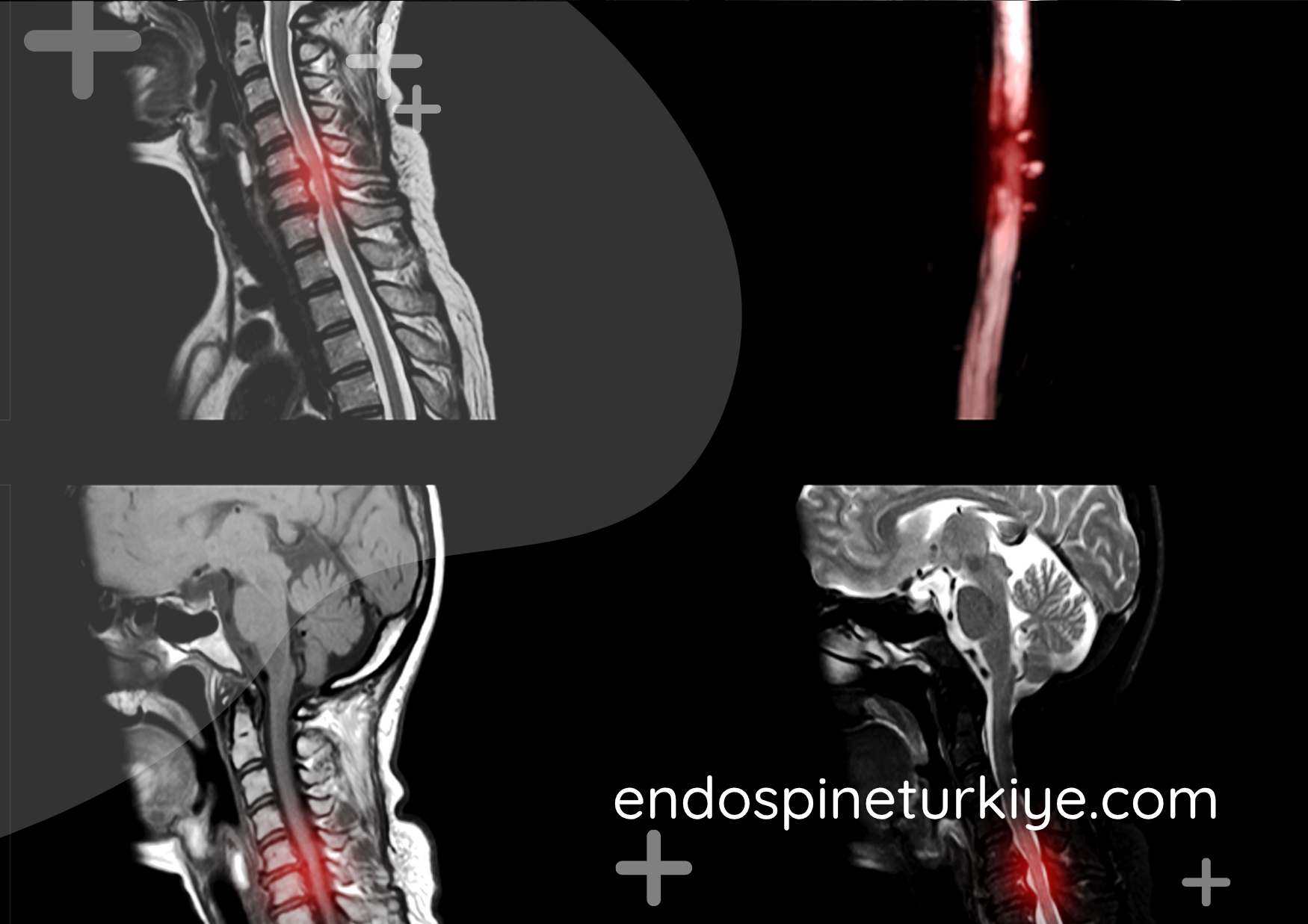 Boyun fıtığı belirtileri - boyun ve kol ağrısı