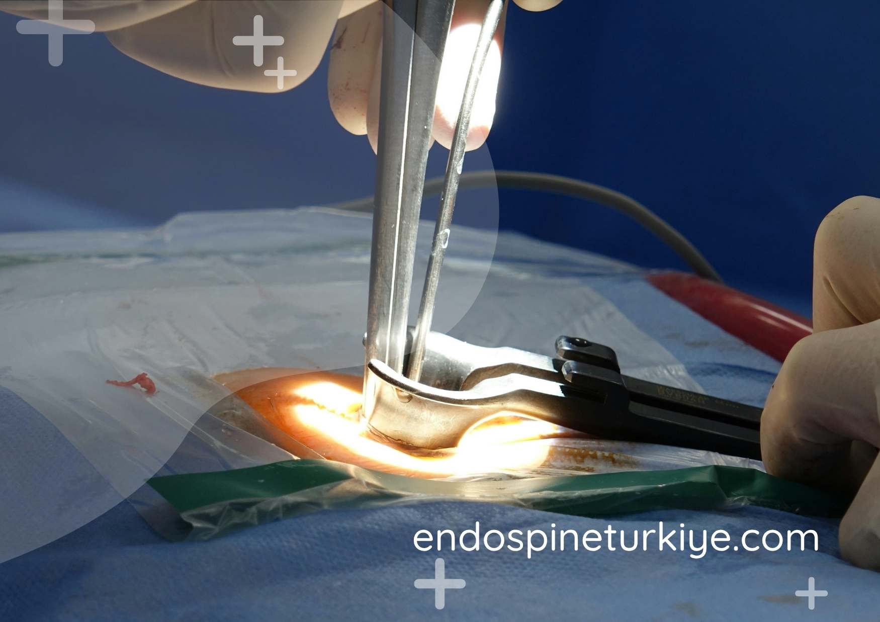 Tam kapalı dar kanal ameliyatı - endoskopik kanal darlığı tedavisi