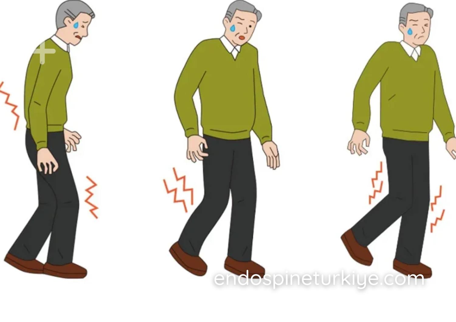 Tam kapalı dar kanal ameliyatı sonrası yürüme iyileşmesi