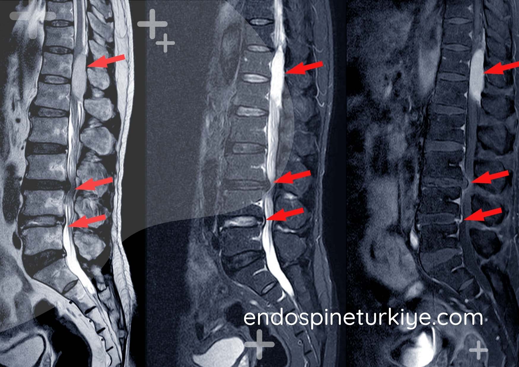 Tam kapalı dar kanal ameliyatı öncesi lomber MR - kanal darlığı teşhisi