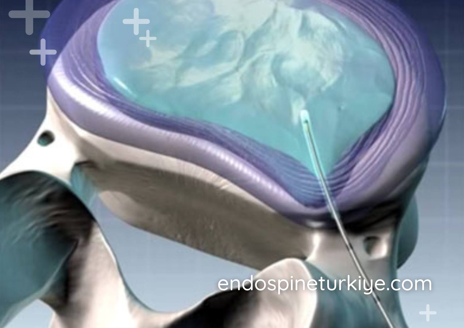 Lazerle bel fıtığı tedavisi PLDD - ameliyatsız lazer nükleoplasti